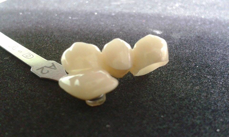 Coroana zirkonium 800 lei